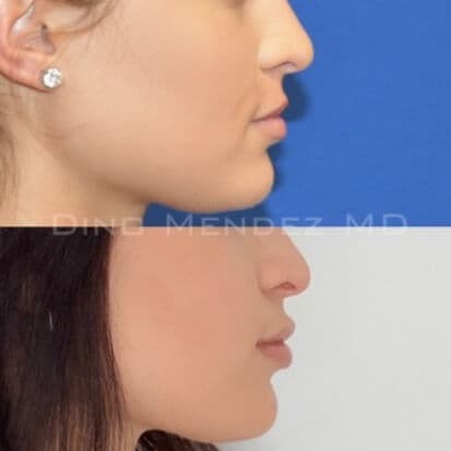 pinnacleskin.com /treatments/injectable-fillers Carousel 1 Image 3