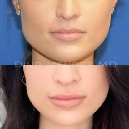pinnacleskin.com /treatments/injectable-fillers Carousel 1 Image 2