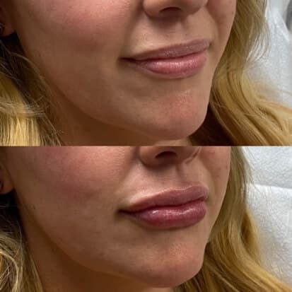 pinnacleskin.com /treatments/injectable-fillers Carousel 1 Image 1