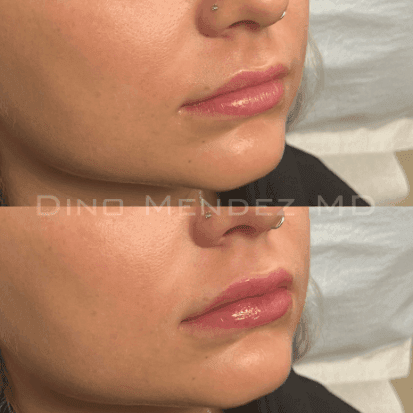 pinnacleskin.com /treatments/injectable-fillers Carousel 1 Image 5