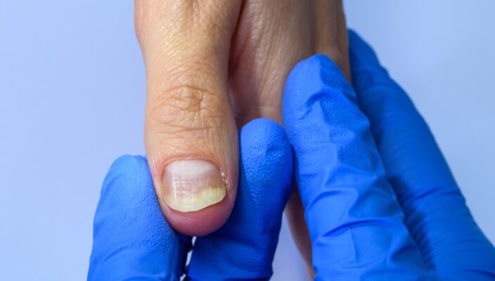 dermatologist inspecting nail)