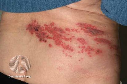 Shingles Treatment Options: What Works Best | Dermatology Blog ...